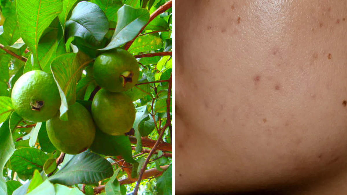 Guava leaves face pack for acne and blackheads