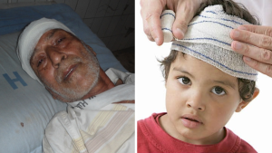 Head injuries
