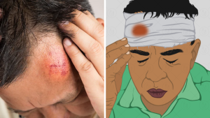 Head Injuries: When a Head Bump Is Dangerous and Needs Immediate Medical Attention
