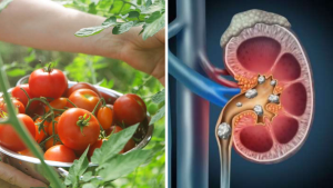 Kidney Stones: Tomato Eating Myth Busted | Causes, Prevention & Facts