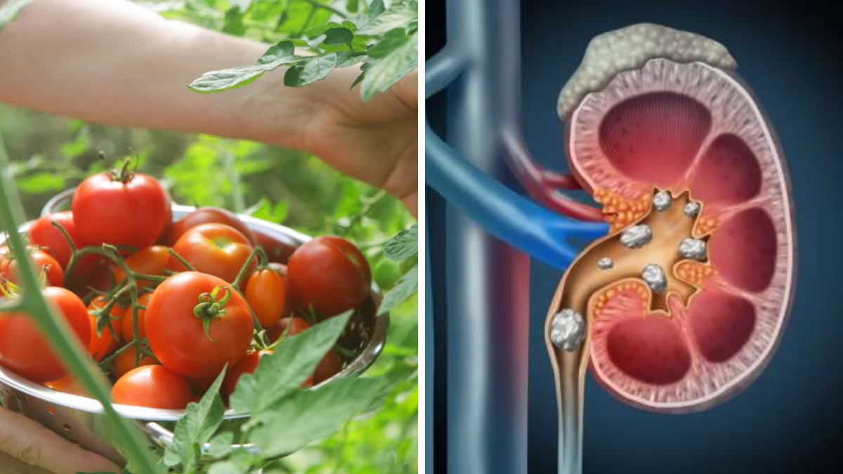 Kidney Stones: Tomato Eating Myth Busted | Causes, Prevention & Facts
