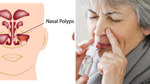 Nasal Polyps