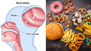 Nasal Polyps Diet: Avoid These Foods to Reduce Nasal Blockage and Sinus Inflammation