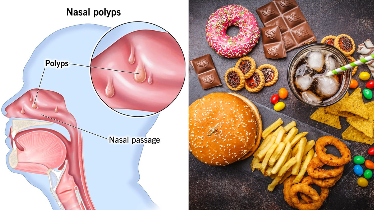 Nasal Polyps Diet: Avoid These Foods to Reduce Nasal Blockage and Sinus Inflammation