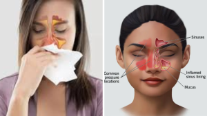 Sinus Problem Diet Tips – Foods to Eat and Avoid for Sinus Relief