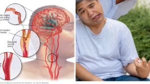 Stroke