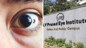 LV Prasad Eye Institute | కంటి పుట్టుమచ్చలకు శస్త్రచికిత్స లేకుండా లేజర్ చికిత్స