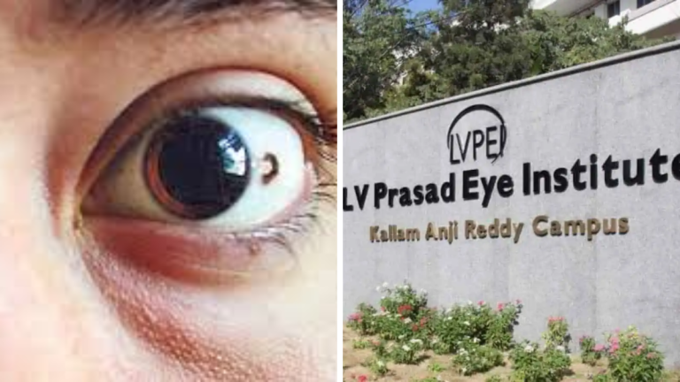 LV Prasad Eye Institute | కంటి పుట్టుమచ్చలకు శస్త్రచికిత్స లేకుండా లేజర్ చికిత్స